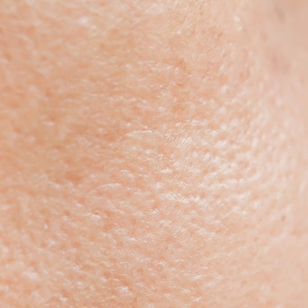 Artigo sobre a acne - imagem principal