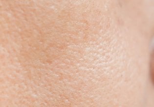 pele com acne