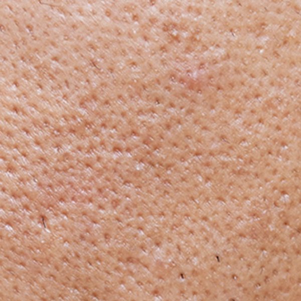 Artigo sobre a acne - imagem principal