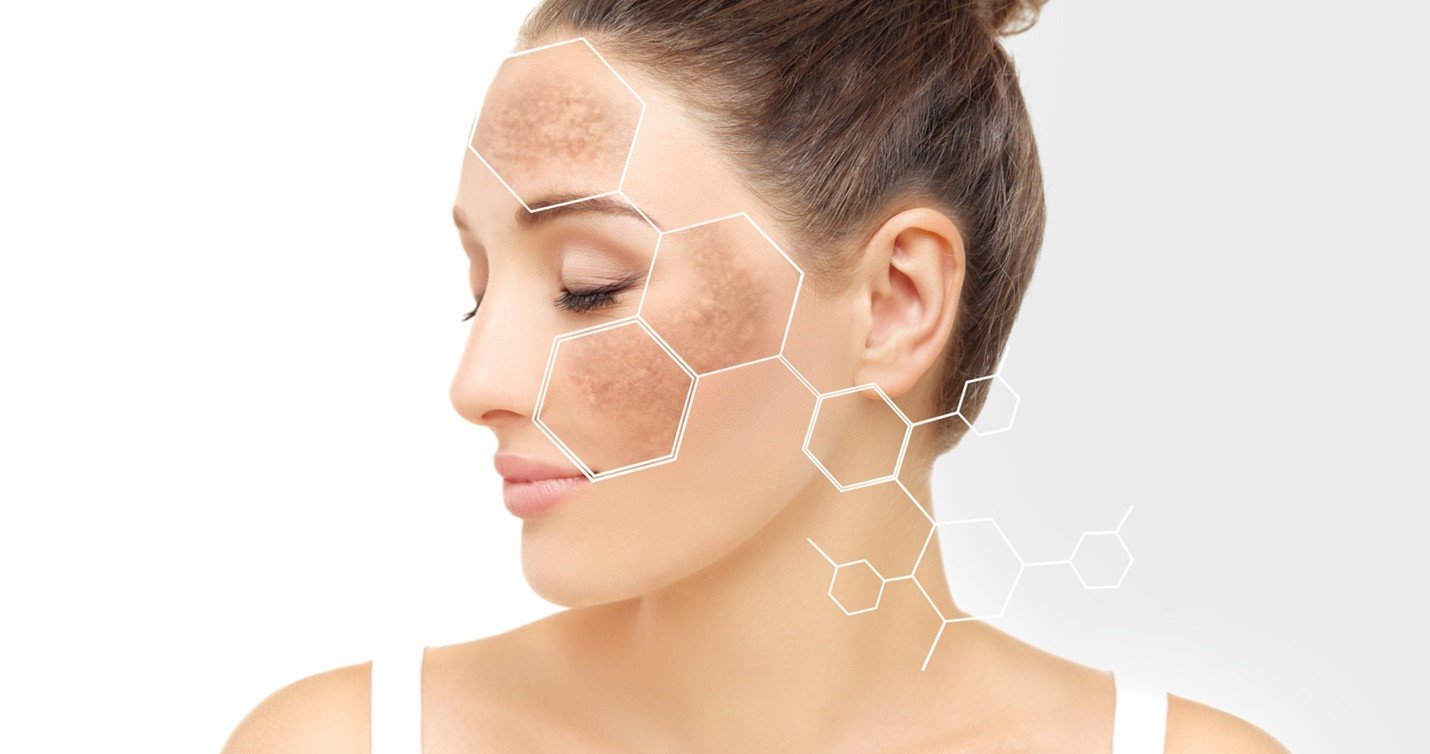 Imagem de mulher com manchas no rosto e com o desenho de uma formúla de produto la roche posay