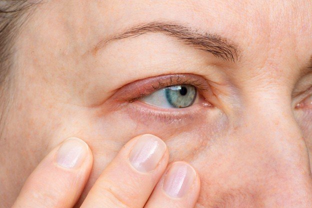 alergia nas palpebras