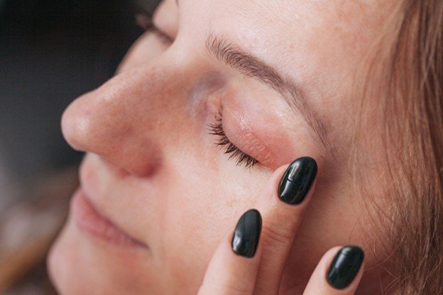 alergia à volta dos olhos