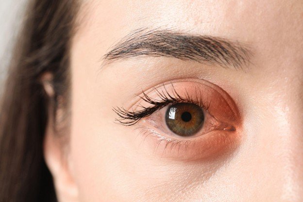 alergia em volta dos olhos o que pode ser