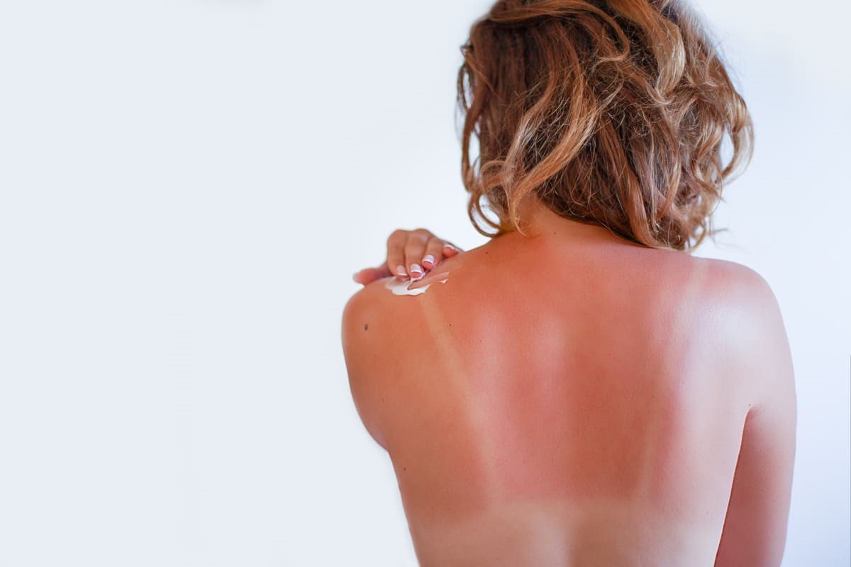 <strong>Aprende a cuidar das queimaduras solares</strong>