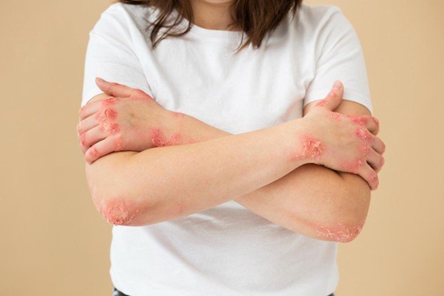 dermatite de contacto