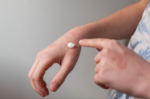 eczema de contacto