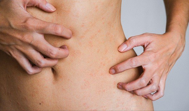 eczema de contacto alérgico