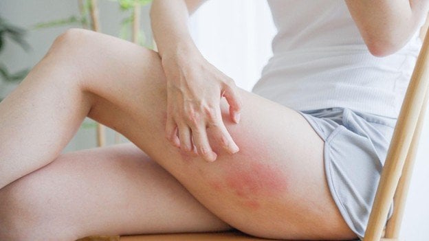 <strong>Foliculite: causas, prevenção e tratamento</strong>