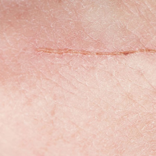 cicatrização de feridas: Como acelerar o processo de cicatrização de feridas