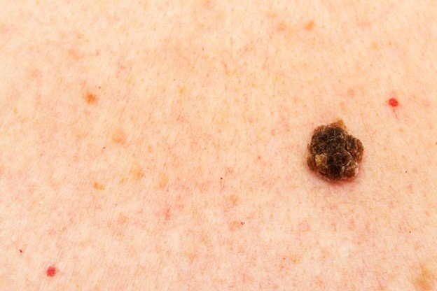 queratose seborreica cuidado