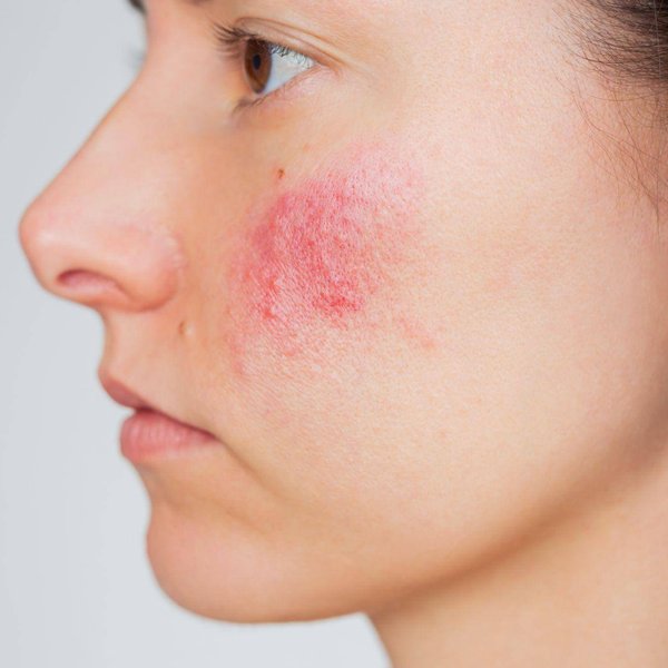 Psoríase: quais são os sintomas e como aliviá-la | La Roche-Posay