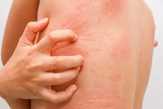 <strong>Erupções cutâneas com prurido:</strong><br> Como tratar as erupções cutâneas no rosto