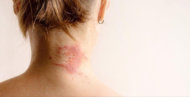 <strong>Dermatite atópica: O que é e como aliviá-la?</strong>