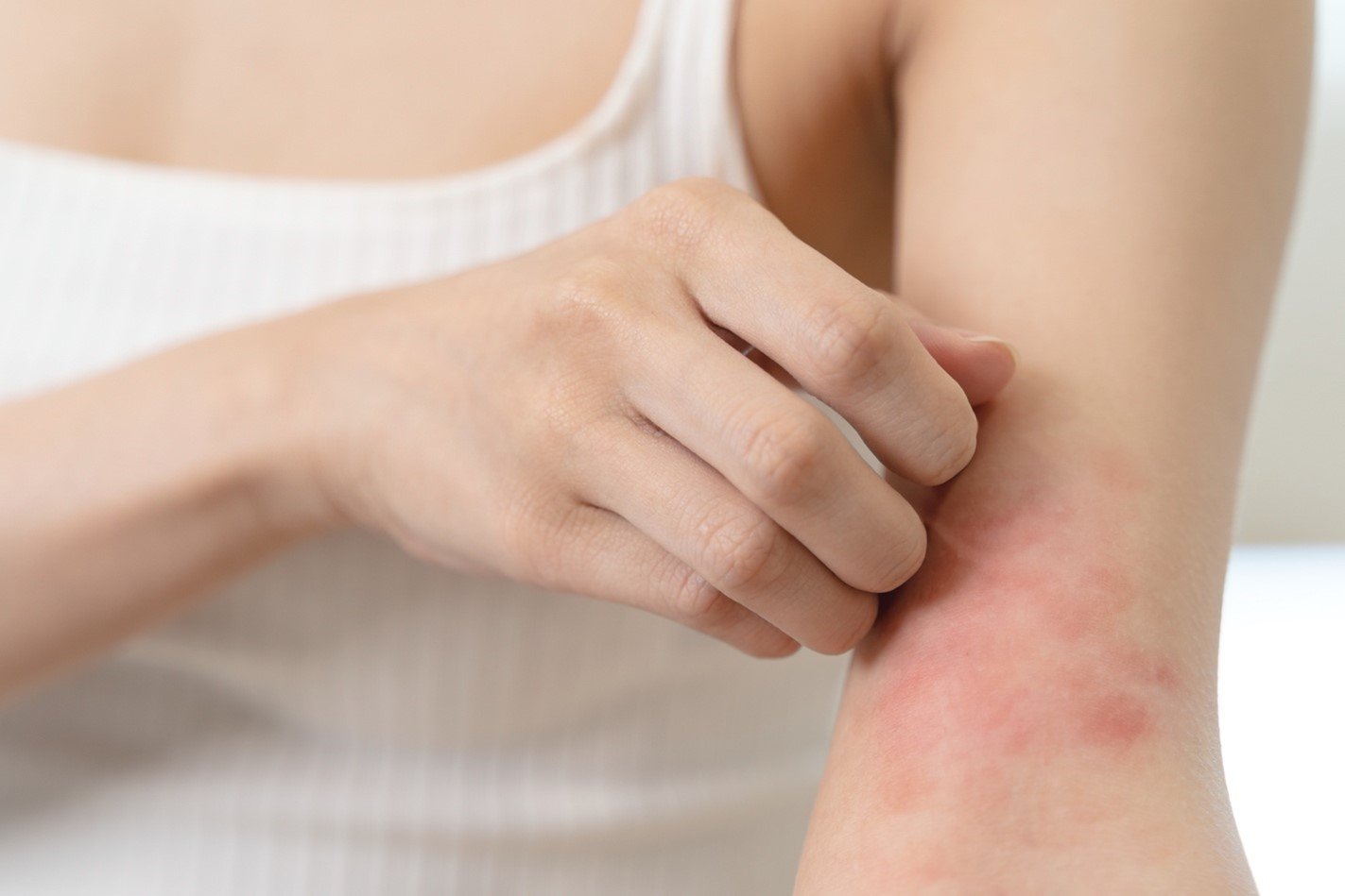 Mulher com dermatite atópica no braço