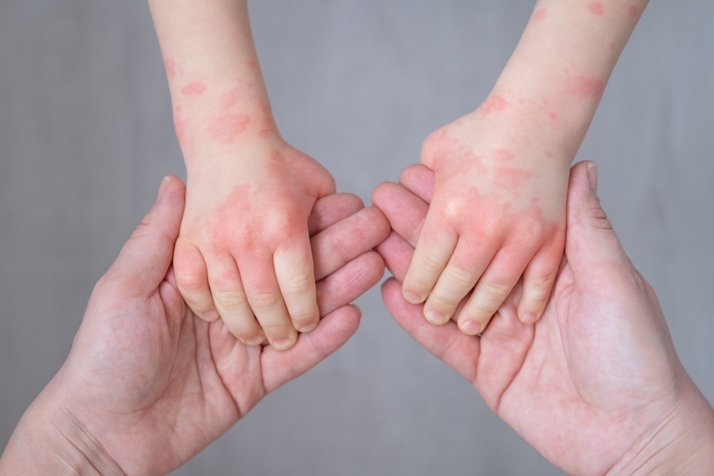 Mãos de criança com dermatite atópica