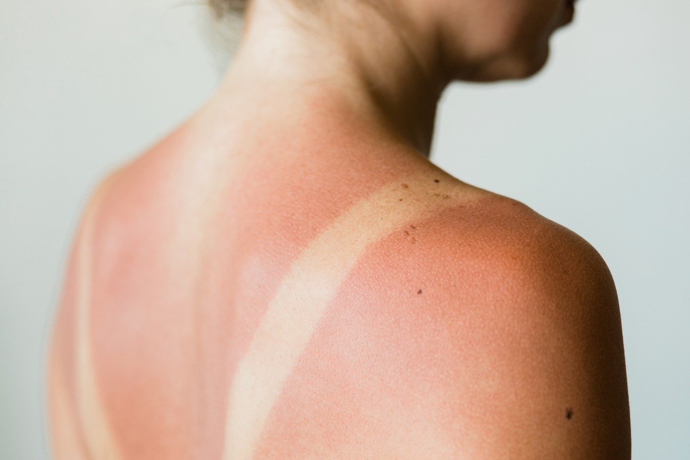 Pele de mulher queimada pelo sol