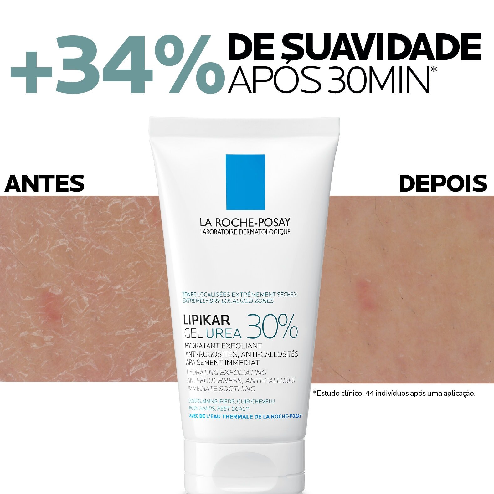 LIPIKAR GEL UREA 30% | Antes e depois