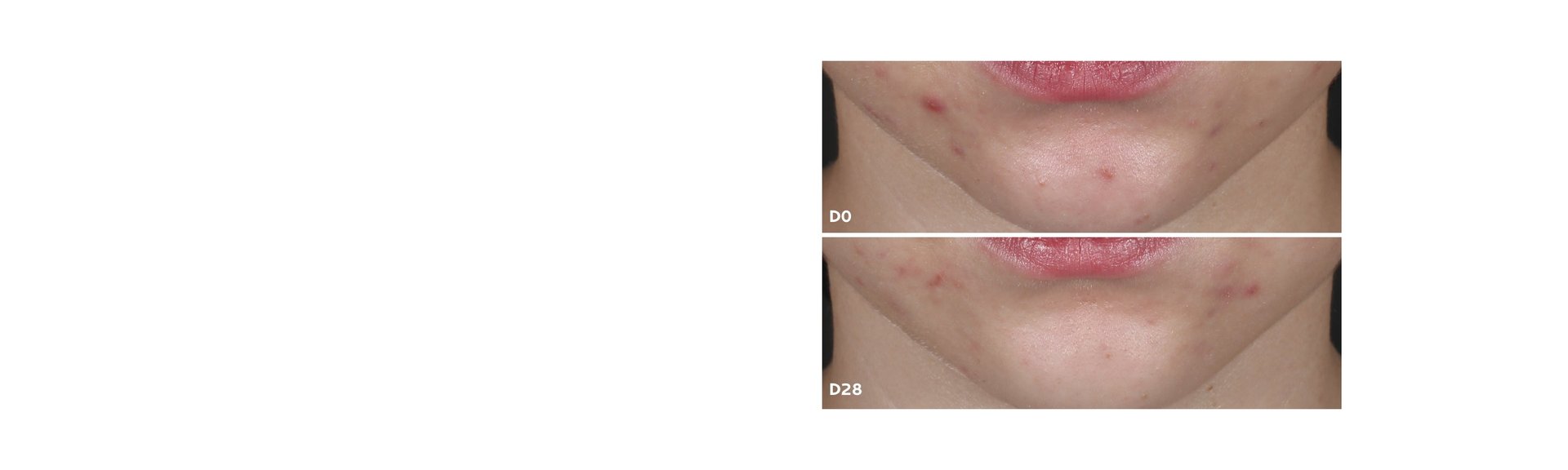 compromisso tratamento de acne